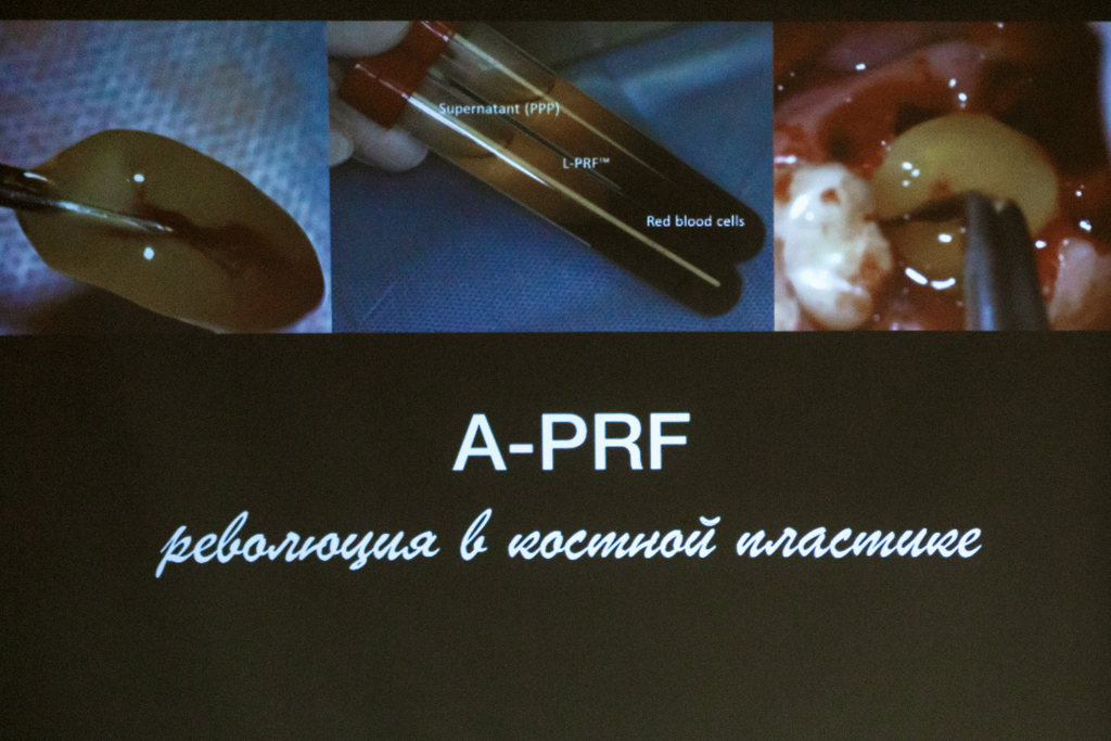 Применение факторов роста (IPRF, APRF)     в стоматологии