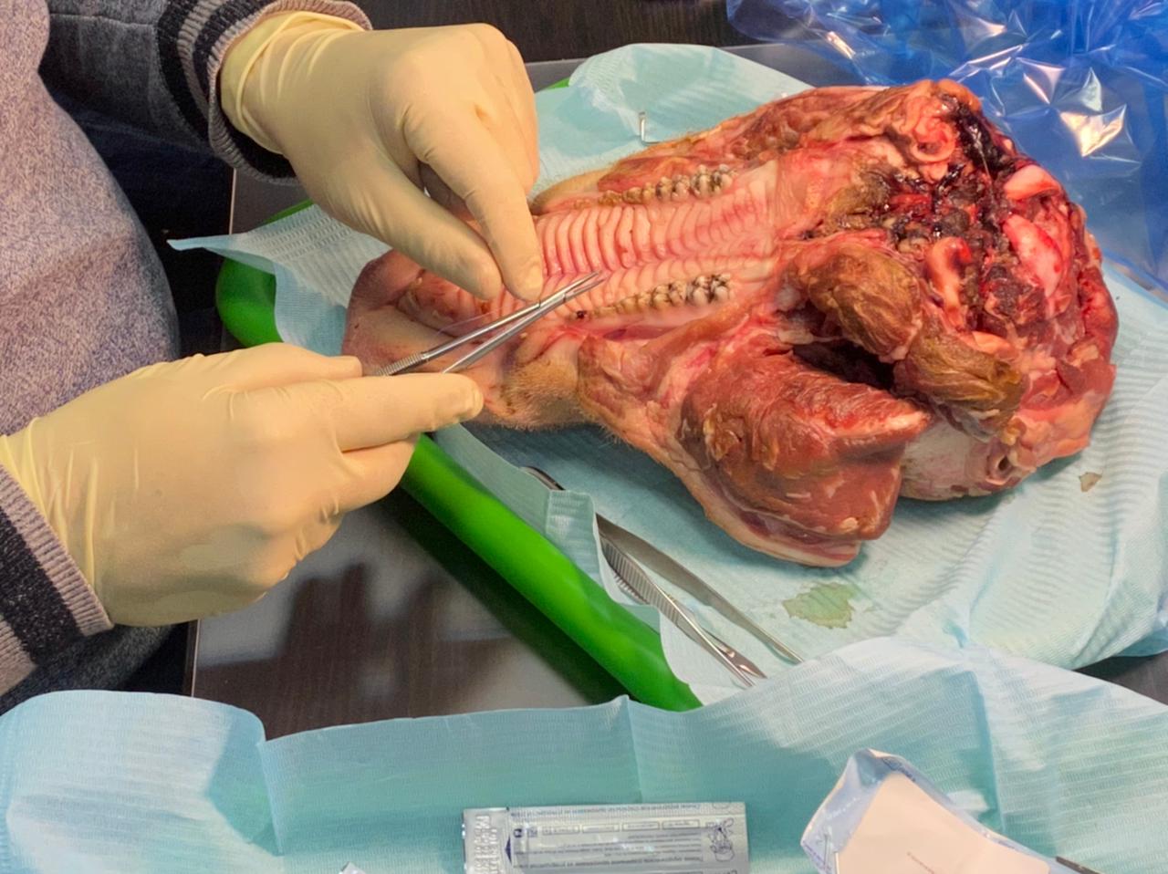 Дентальная имплантация с одновременной пластикой мягких тканей в сложных клинических случаях. 3 апреля 2021