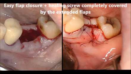 EXTRACTION + IMMEDIATE IMPLANT 2