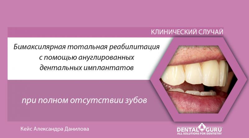 Бимаксилярная тотальная реабилитация с помощью ануглированных дентальных имплантов при полном отсутствии зубов