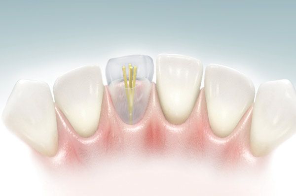 Восстановление контрфорсов жевательной группы зубов с помощью стекловолоконных конструкций