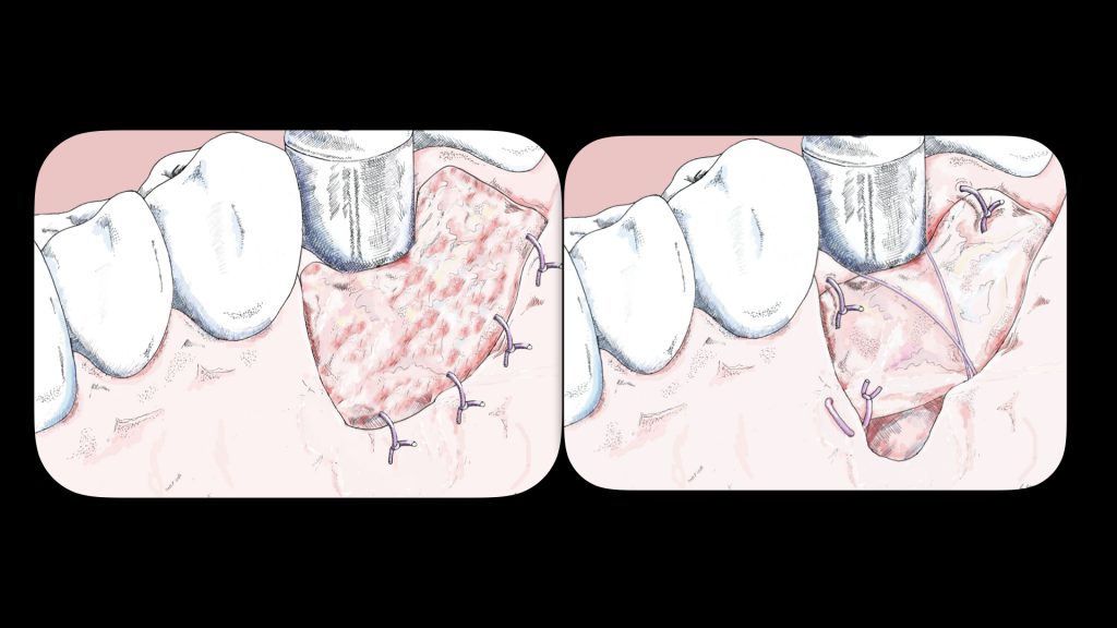 Рис. 3: Схематические рисунки, показывающие подготовку ложа реципиента и фиксацию свободного десневого трансплантата (Рисунки доктора Гвидо Гори)