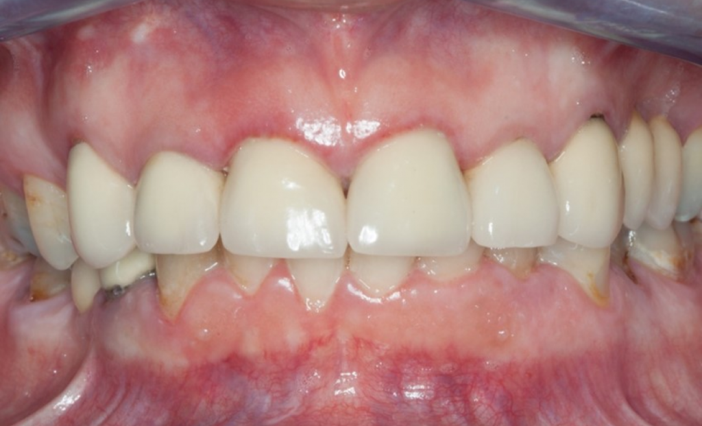 Рис.17: Клинический снимок с переломом зуба 21