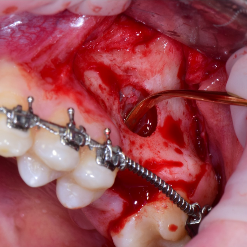 Отсроченная имплантация AnyRidge и синус-лифтинг на этапе ортодонтического лечения. Кейс Артема Митюшина