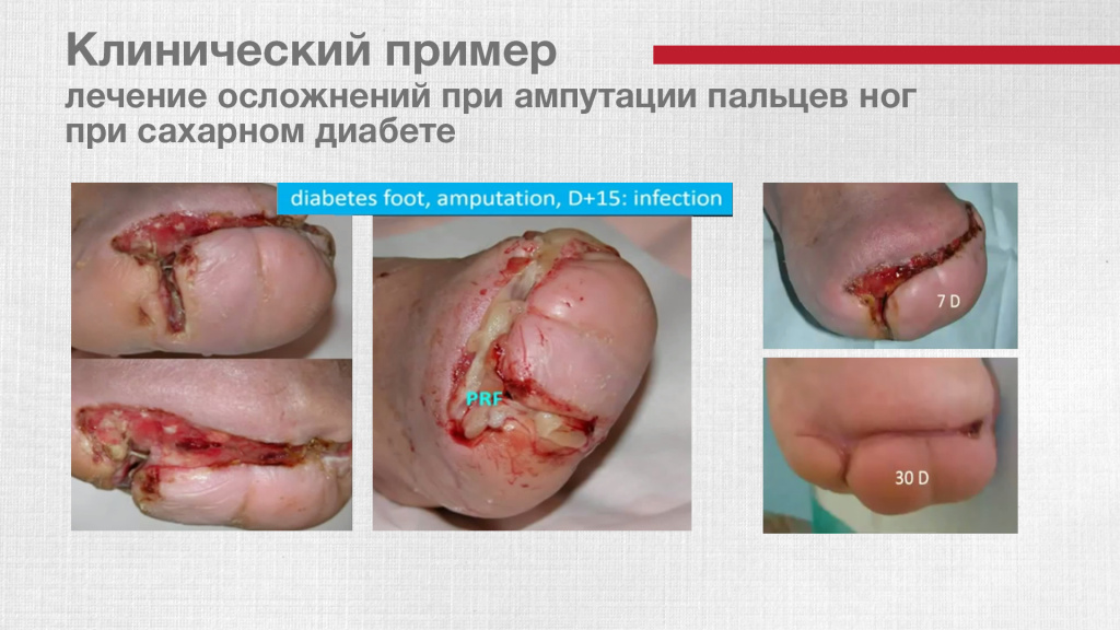 Клинические примеры: лечение синдрома Лайеля (некроза кожи) и лечение осложнений при ампутации пальцев ног при сахарном диабете.