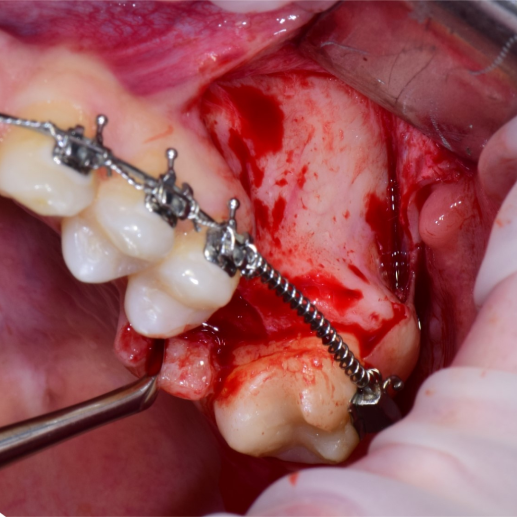 Отсроченная имплантация AnyRidge и синус-лифтинг на этапе ортодонтического лечения. Кейс Артема Митюшина