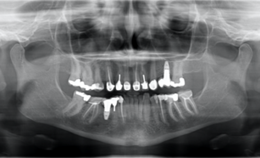  Рис.16: РГ-снимок с переломом зуба 21