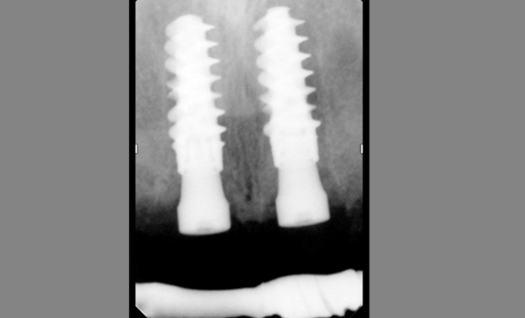 Рис.18: Удалены 4 зуба с одновременной установкой двух имплантатов 4,5 мм x 12 мм. Установлены заживляющие абатменты размером 2,5 х 4,3 мм. На период реабилитации был установлен временный мостовидный протез, поддерживаемый зубами 13 и 23