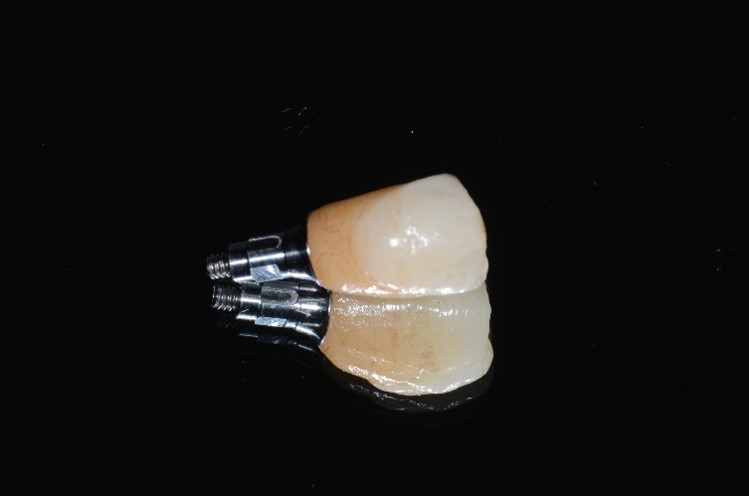 Гибридный абатмент-коронка был зацементирован на базовую вставку из титановой смолы, что позволяет ввинчивать фиксацию непосредственно в имплантат.