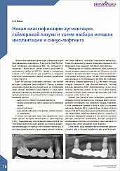 Новая классификация аугментации гайморовой пазухи и схема выбора методов имплантации и синус-лифтинга